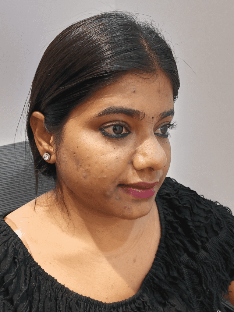 Severe acne before skincare treatment