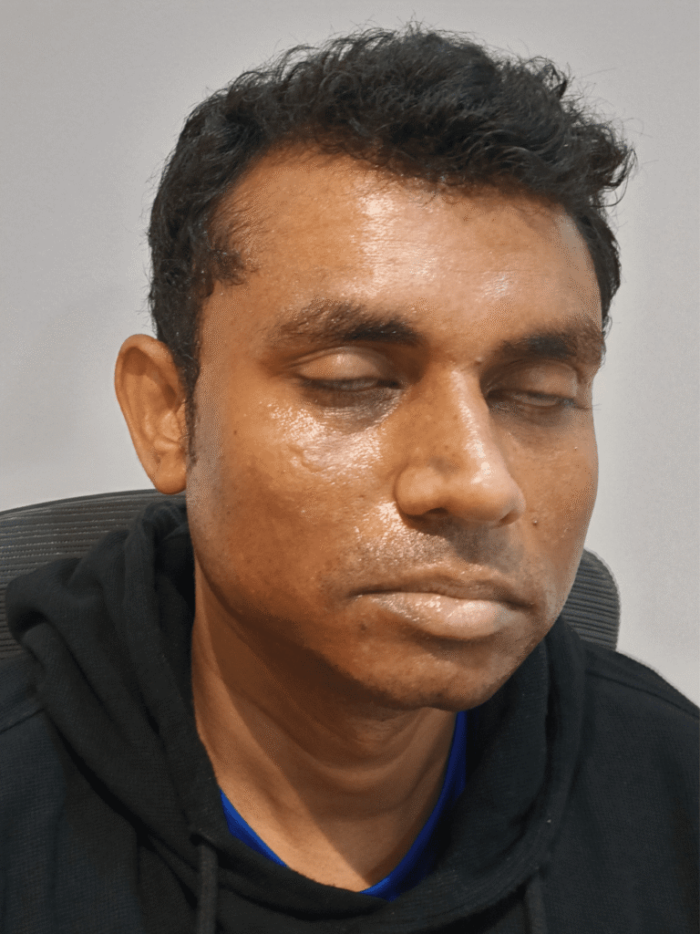 Dry, tired-looking skin before Hydrafacial