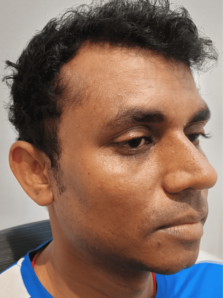 Improved skin texture and radiance after Hydrafacial
