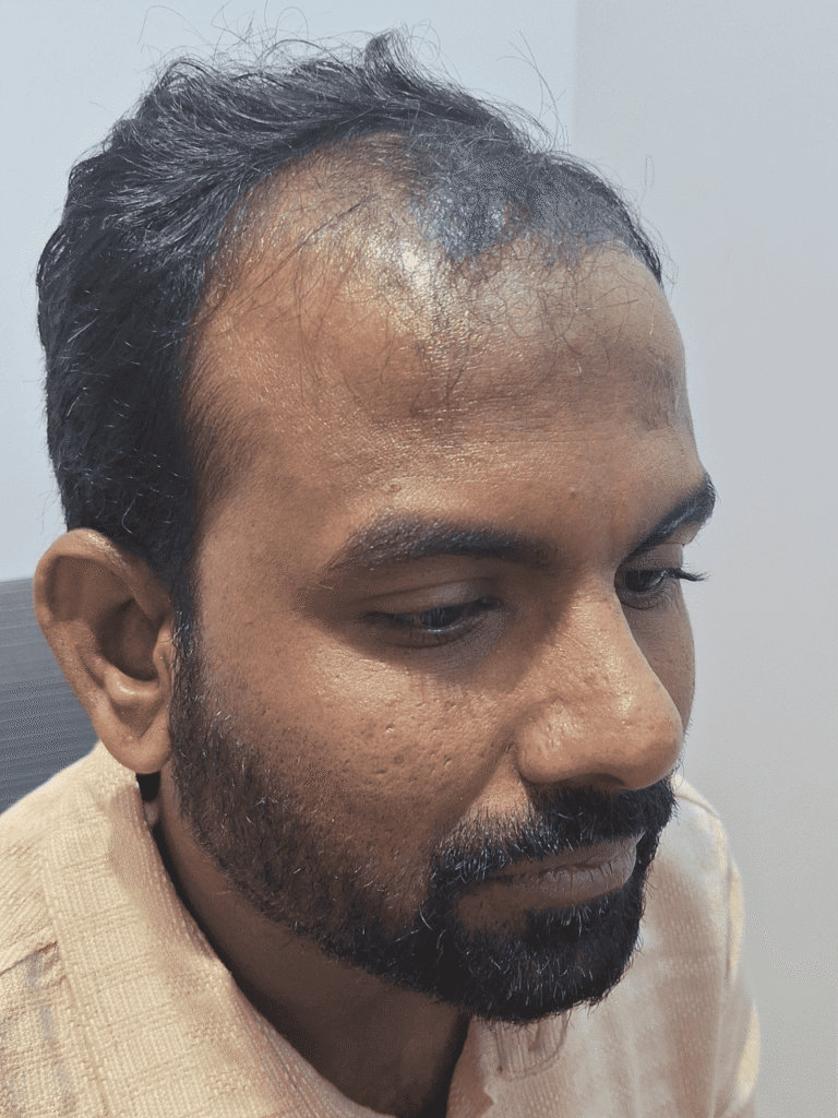 Thin hair before transformation