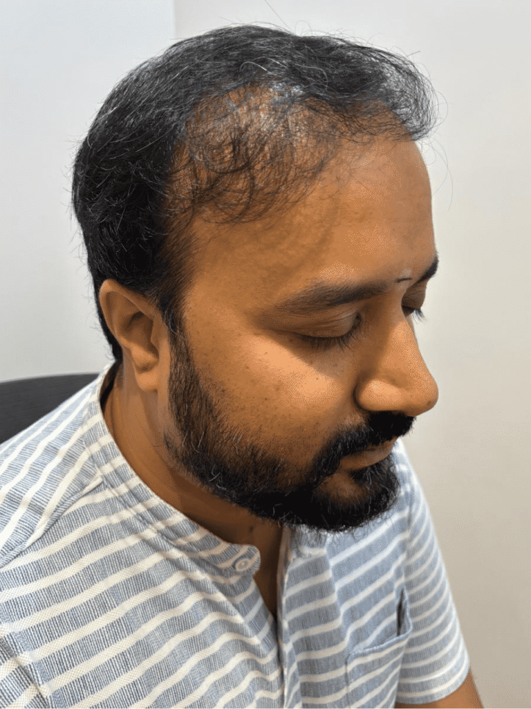 Low hair volume before results