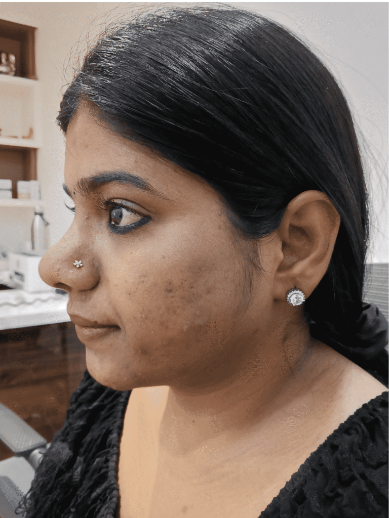 Before treatment: active acne on face