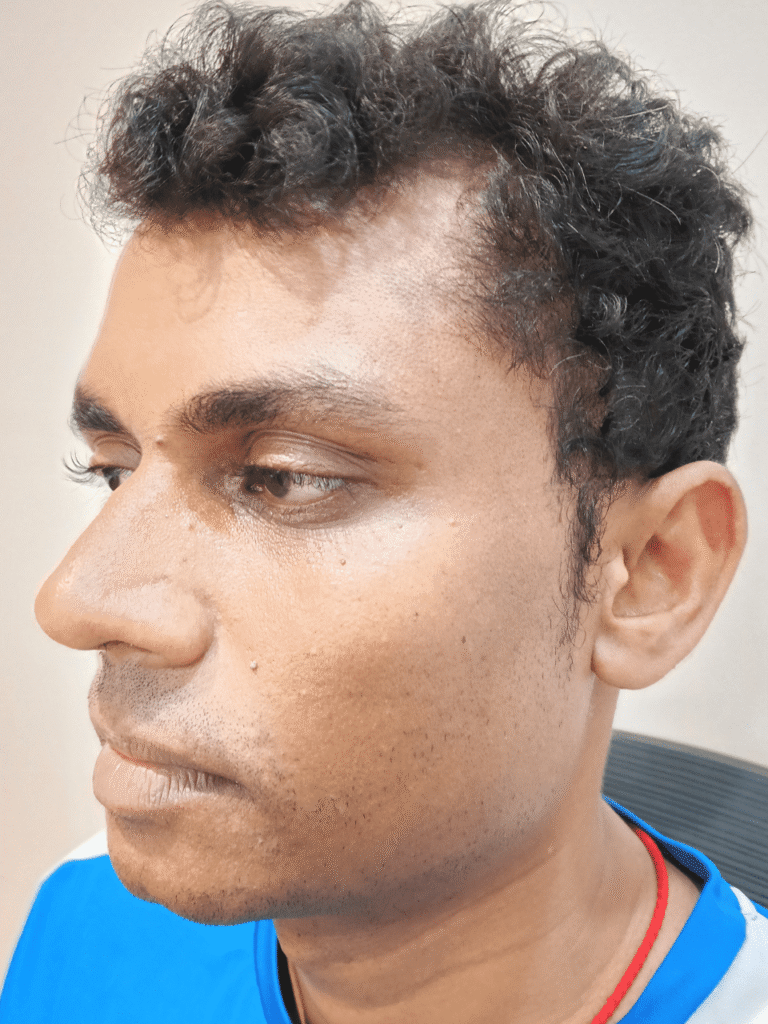 After Hydrafacial: glowing, hydrated skin
