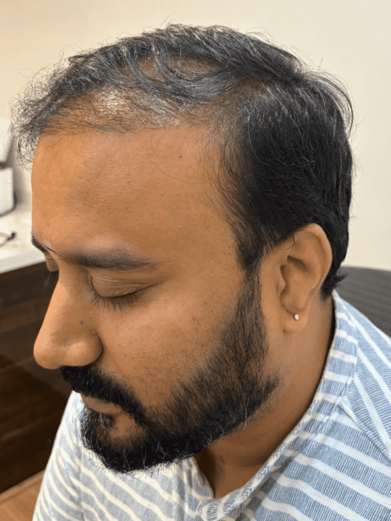 Hair loss condition – before