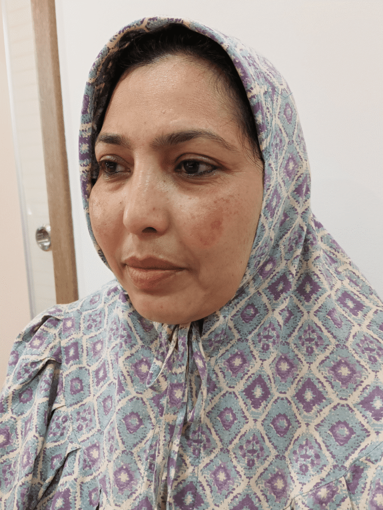 Before treatment: melasma on face