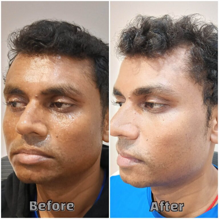 Before & AFter Treatment for Congested skin before Glow Peel