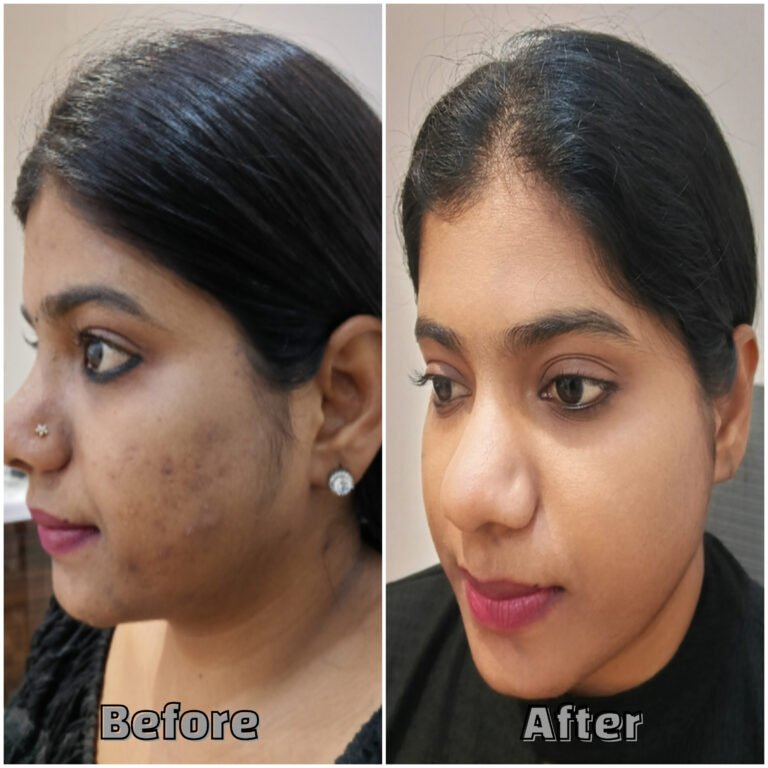 Before & After Back acne with redness Treatment
