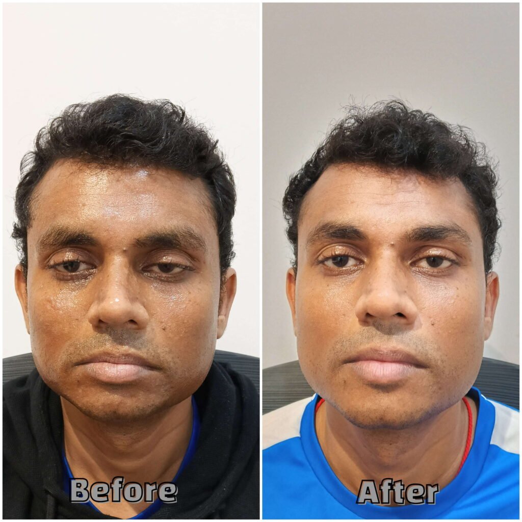Before & After Deep cleansed healthy skin