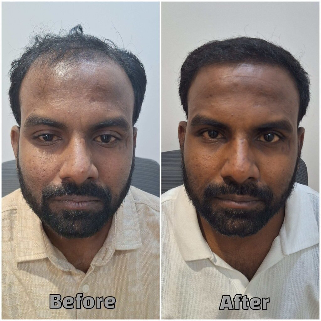 Before & After Front Scalp Exposure