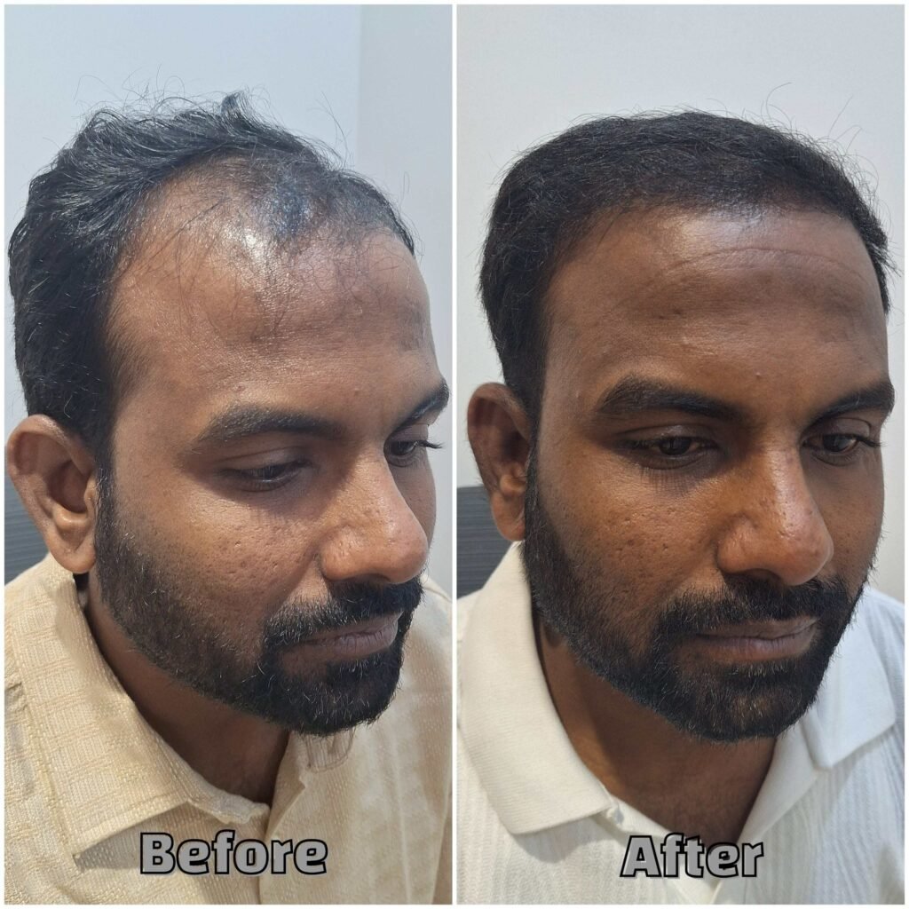 Before & After Hair transplant Suregery