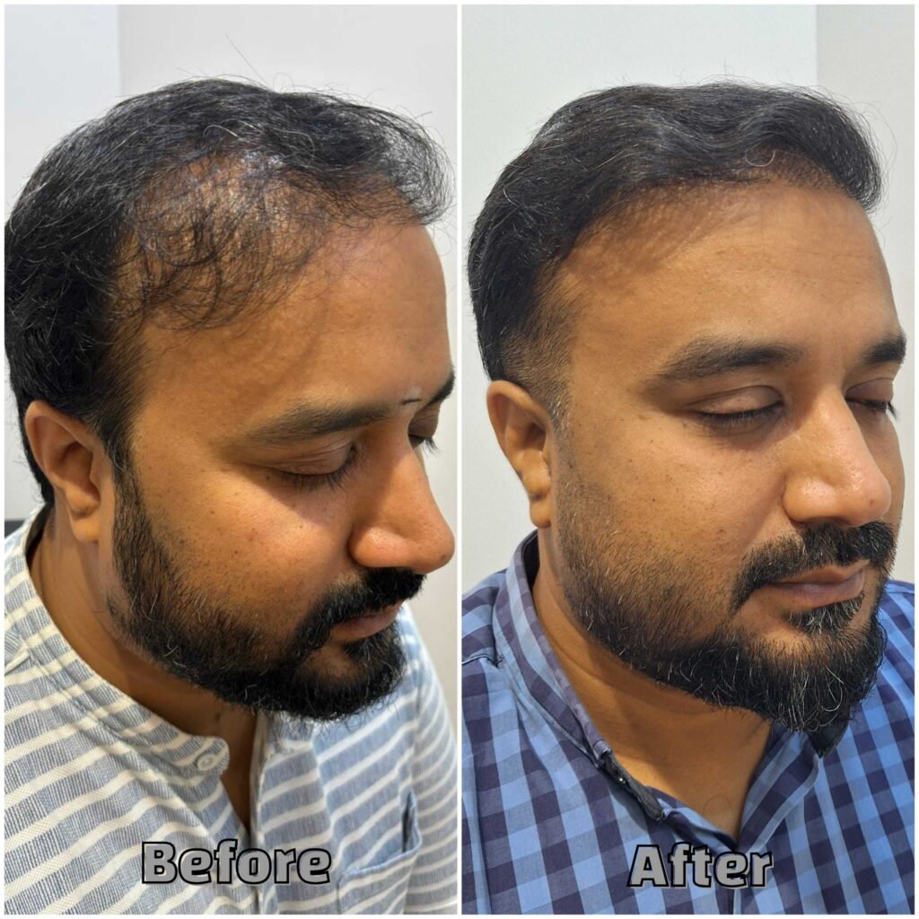 Before & After Patchy hair Treatment