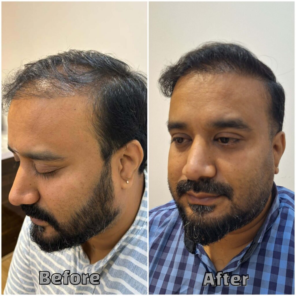 Before & After Thin to thicker hairs