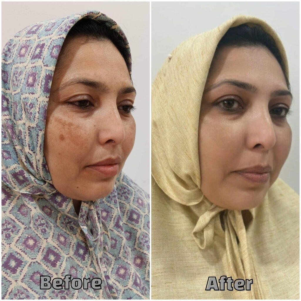 Before & After TreatementUneven skin with pigmentation