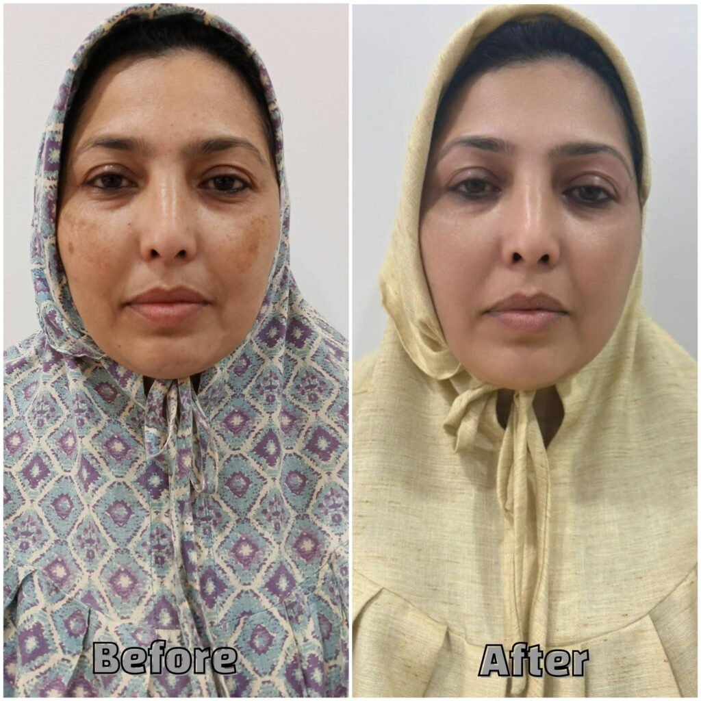 Before & After Treatment Brown spots on cheeks