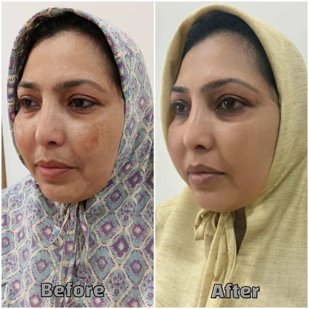 Before& After Treatment Dark spots under eyes