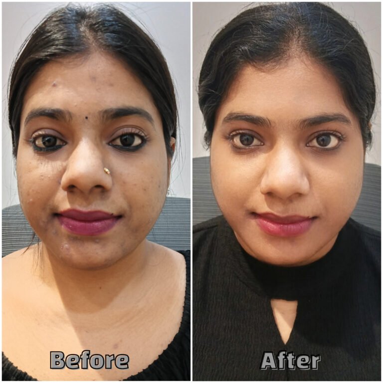 Before & After Treatment Uneven textured facial skin