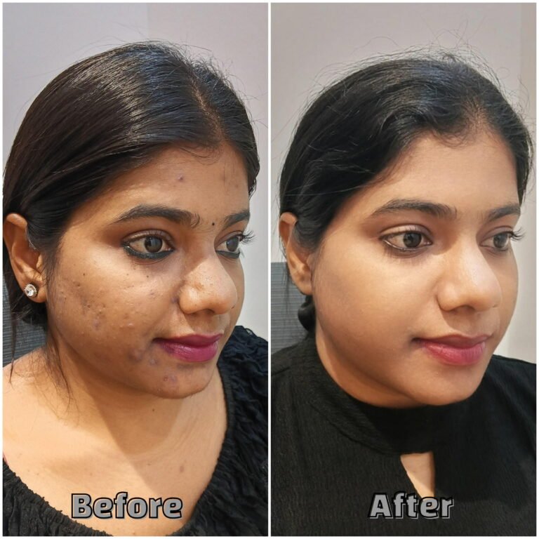 Before & After Treatment of Whiteheads and blackheads visible
