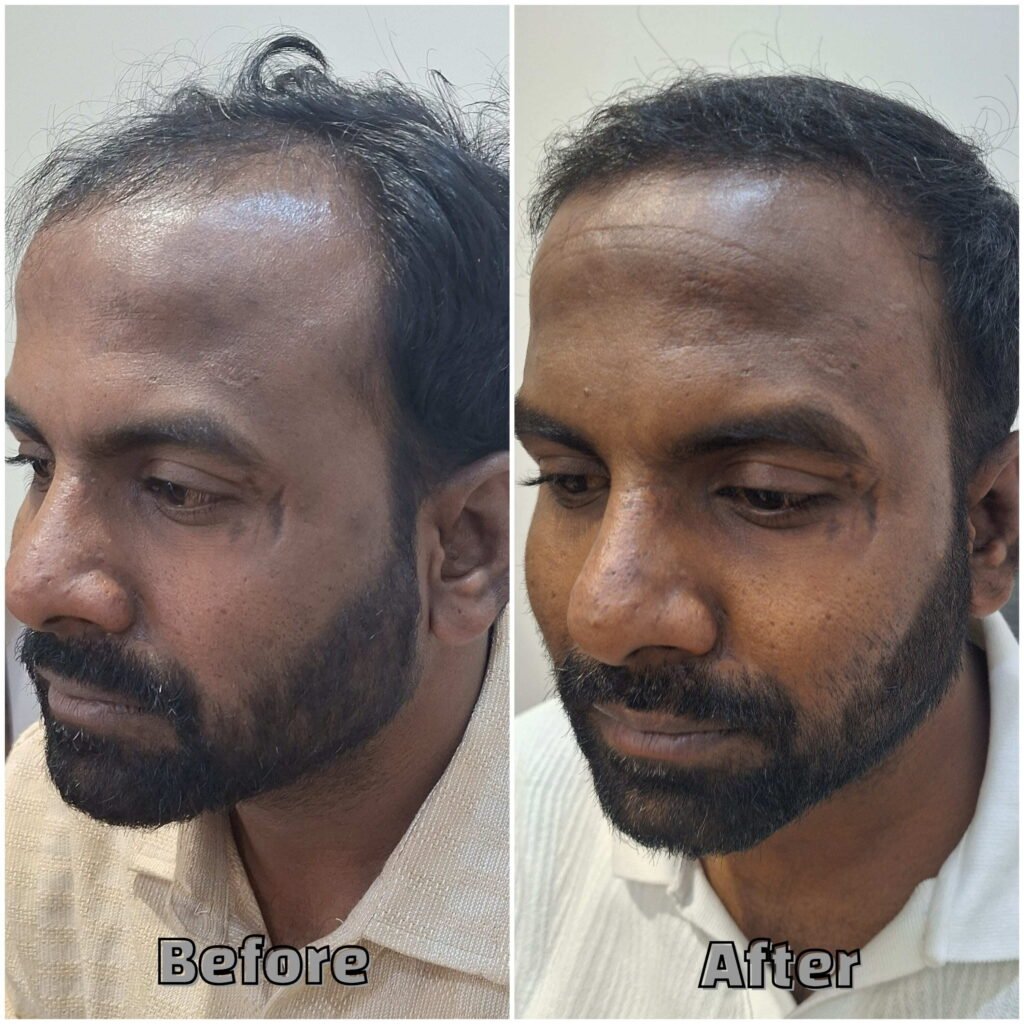 Before& After Uneven hairline Transplant