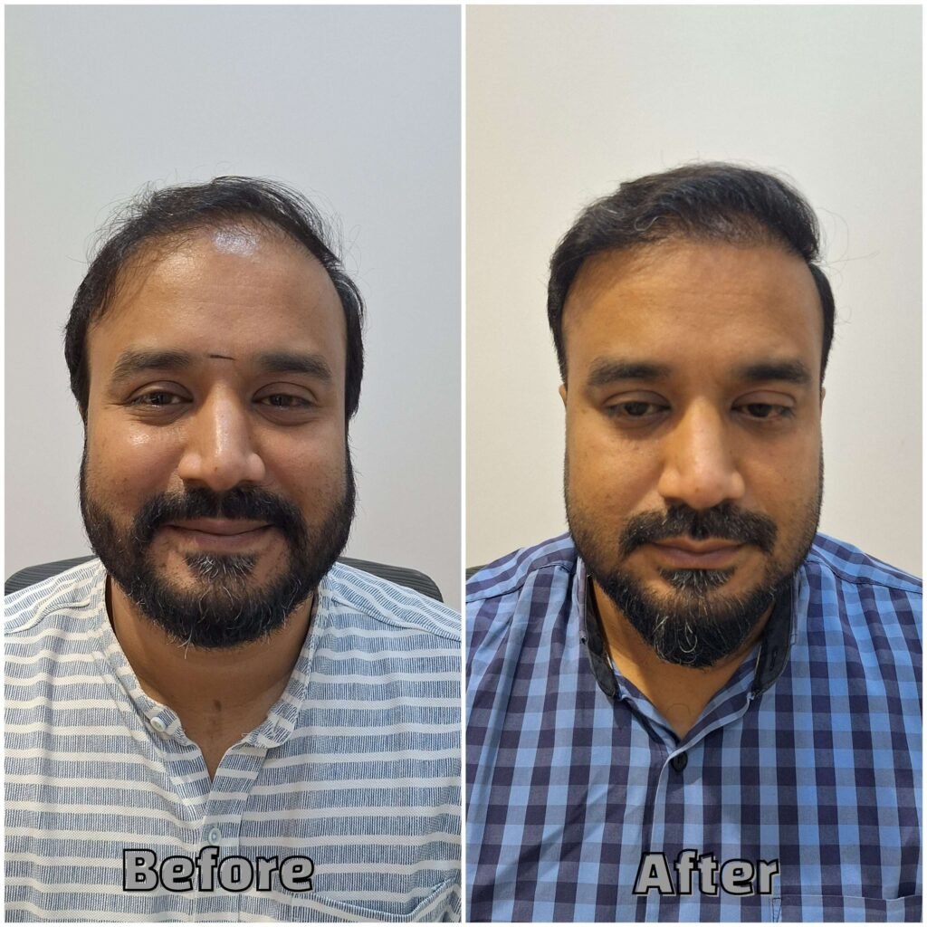 Before & After front hairline