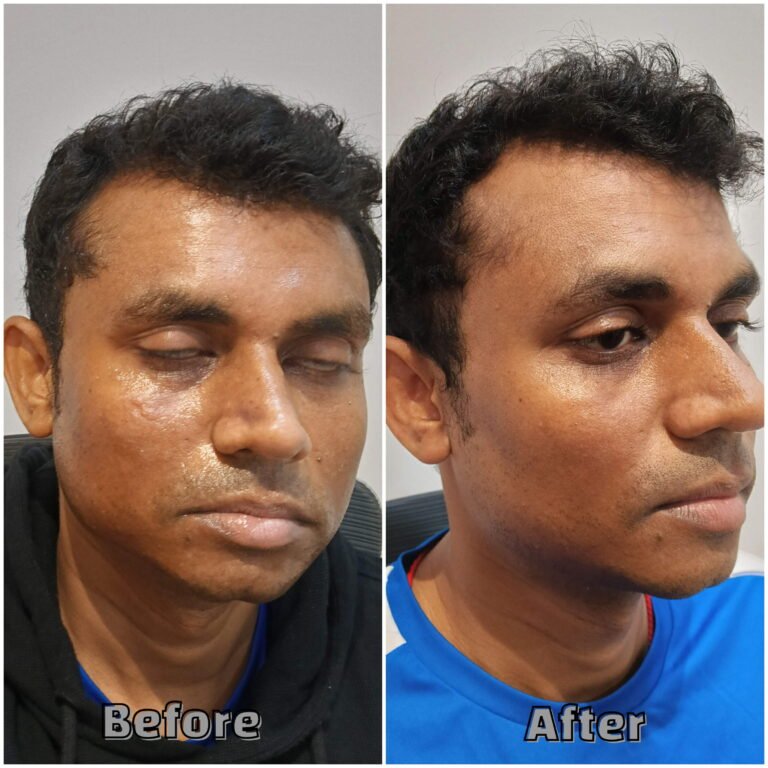 Before & After skin clarity