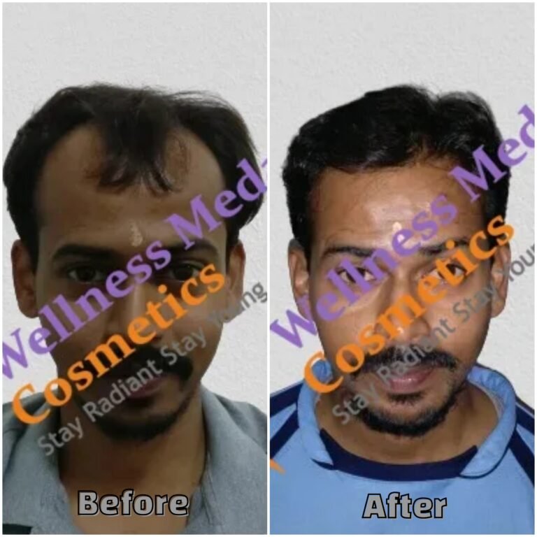 Hair transplant before and after