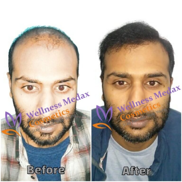 Hairline restoration procedure