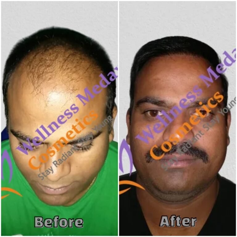 Natural hair growth after transplant